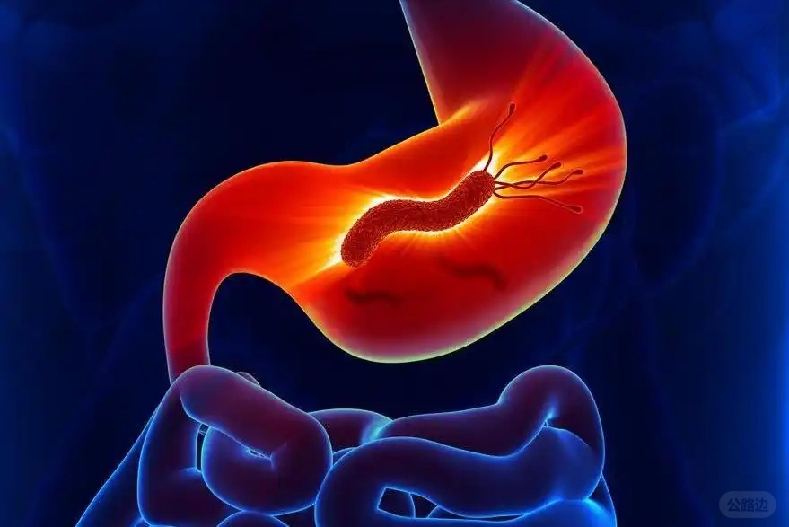 College Student Fond of Street Food Diagnosed with Advanced Gastric Cancer Gastr.jpg