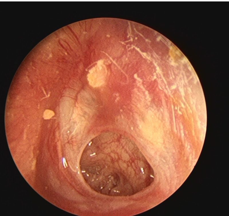 Rhinovirus cold is not flu! Blowing your nose incorrectly can lead to otitis media?-gonglubian